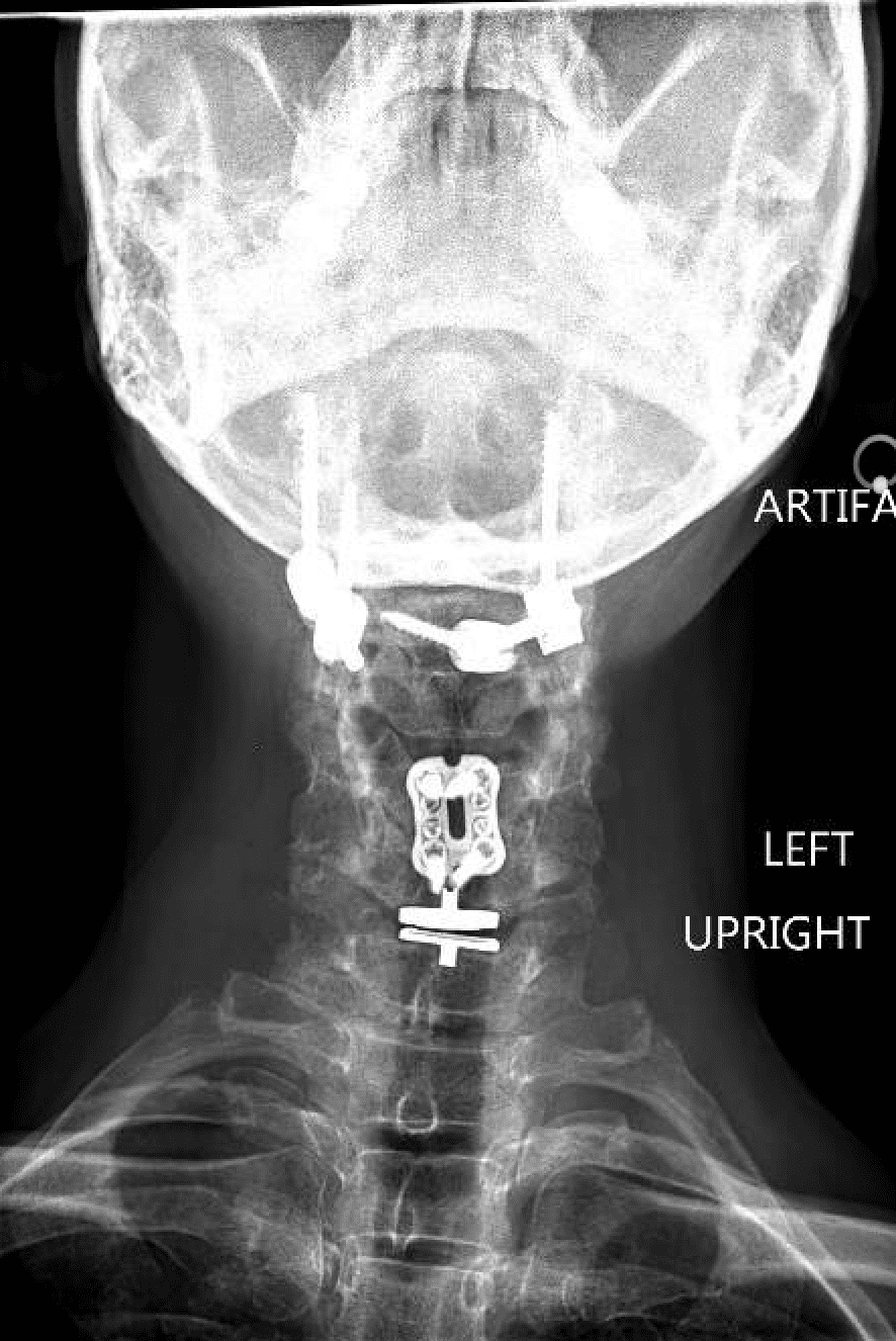 A x-ray of the neck and head showing the location of the implant.