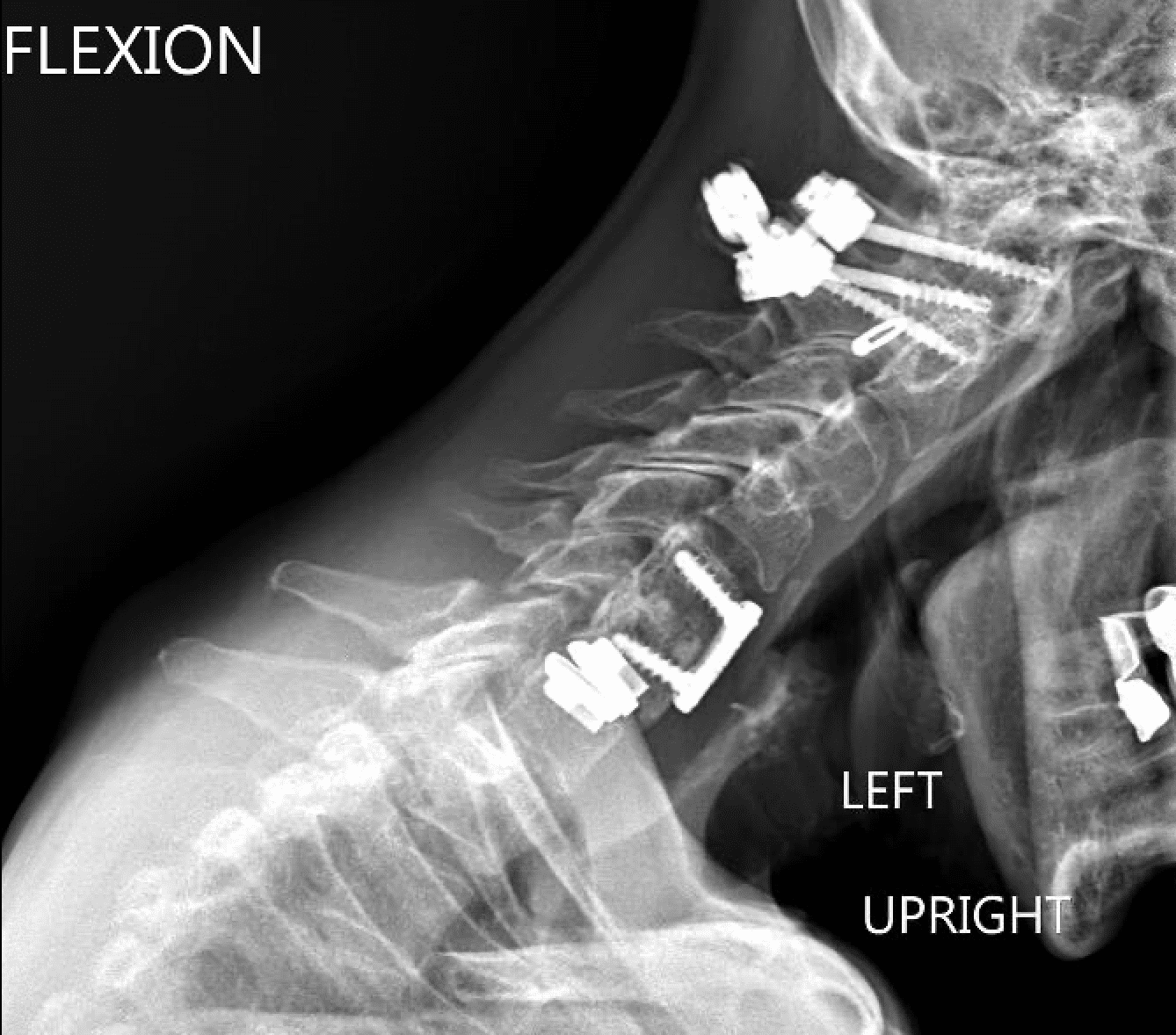 A black and white photo of an x-ray showing the back end.